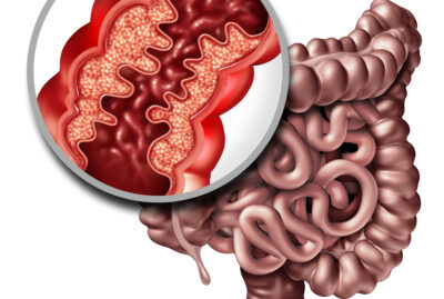 crohns-disease