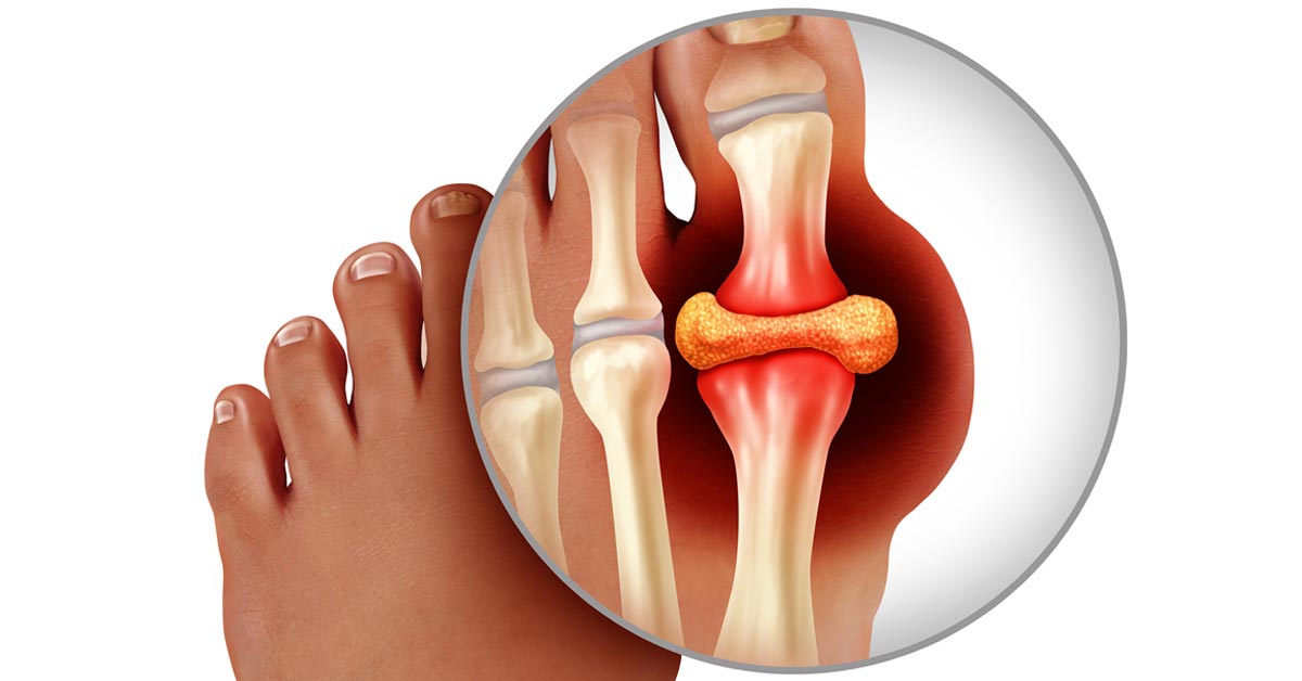 gout-and-high-uric-acid